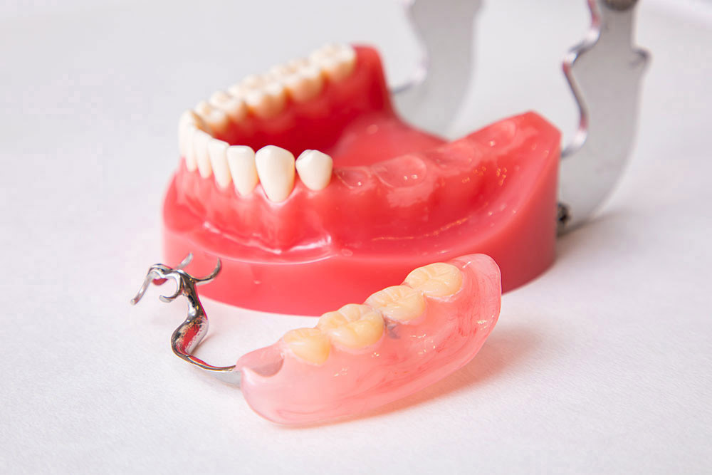 入れ歯との違い