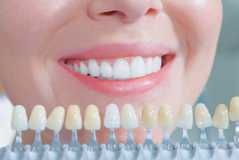 ホワイトニング